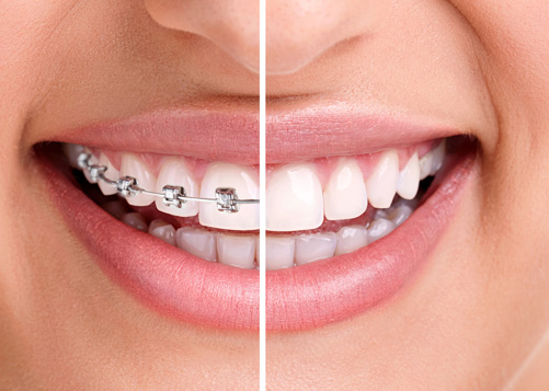 Orthodontic Braces