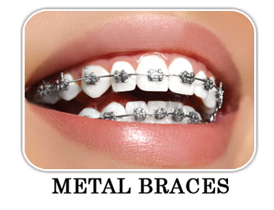 Orthodontic Braces