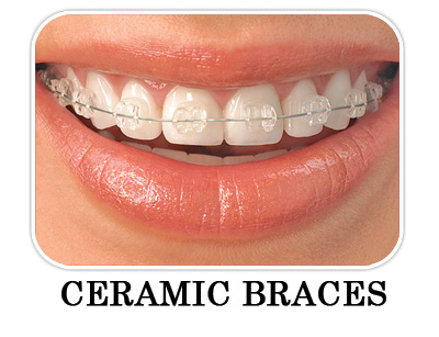 Orthodontic Braces