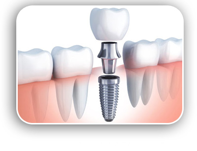 Dental Implants