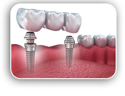 Dental Implants