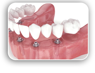 Dental Implants